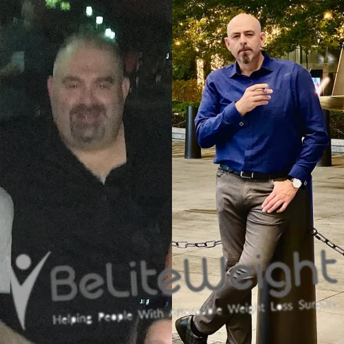 Weight Loss Surgery Gastric Sleeve before and after